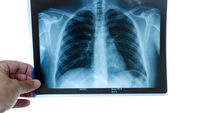 Calls for mobile x-ray to be rolled out quickly in Mayo