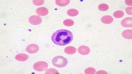 Family of woman who died of cervical cancer settle case