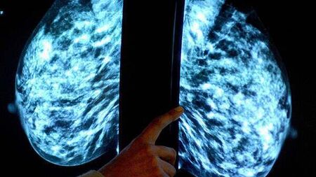 HSE breast cancer screening programme misses targets for past two years