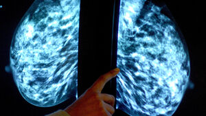 Staffing issues impact MUH mammography service