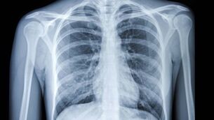 HSE allays fears over asbestos risk at healthcare facilities HSE allays fears over asbestos risk at healthcare facilities